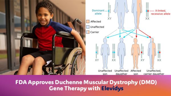 Fda Approved Duchenne Muscular Dystrophy (Dmd) Gene Therapy With Elevidys