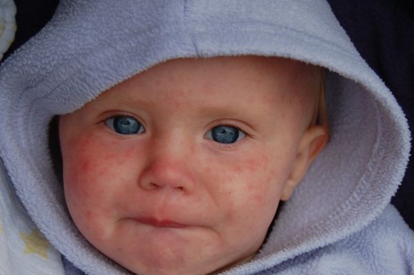 Staying Safe From Measles - Get Your Children Mmr Vaccine